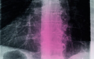 x-ray-back-degenerative-discs-lowback-spine-degeneration-caya-yoga-results