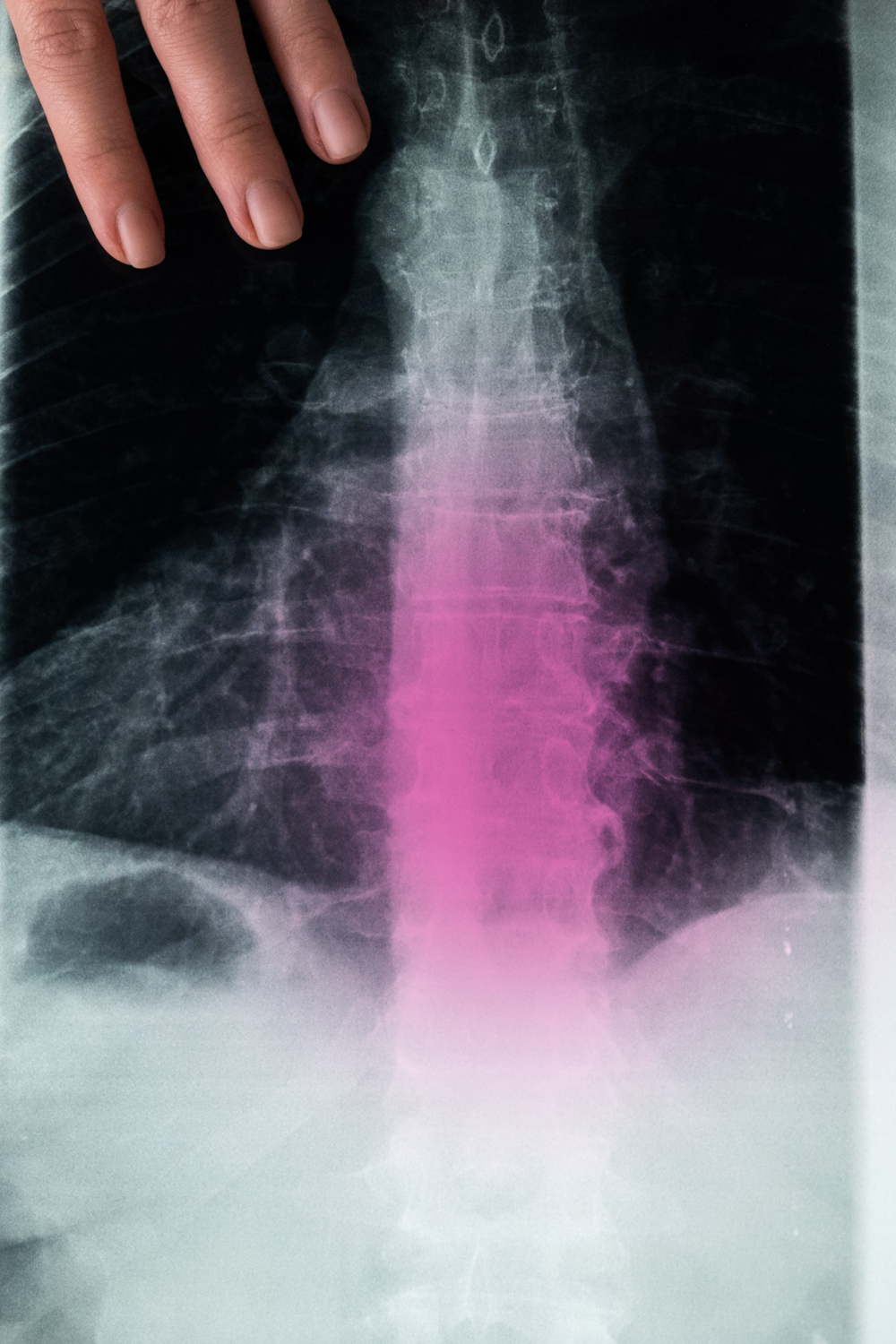x-ray-back-degenerative-discs-lowback-spine-degeneration-caya-yoga-results
