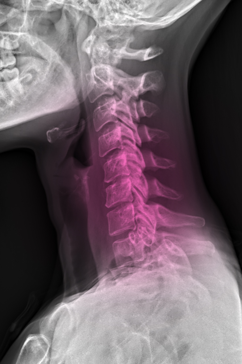 x-ray-compressed-discs-neck-cervical-spine-degeneration-caya-yoga-results