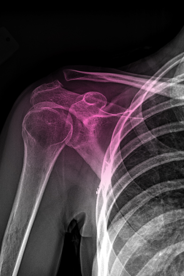 x-ray-shoulder-pain-frozen-joint-pain-caya-yoga-results