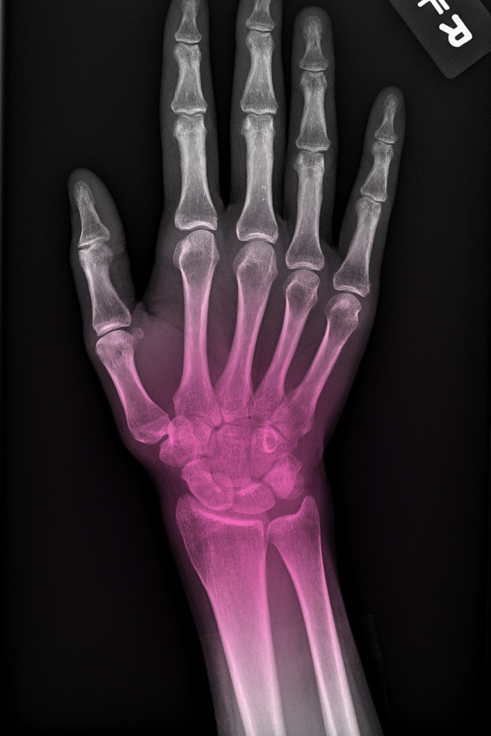 x-ray-wrist-pain-arpel-tunnel-joint-pain-caya-yoga-results